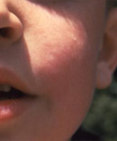 Fifth Disease Source: CDC