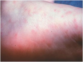Rocky Mountain Spotted Fever Rash